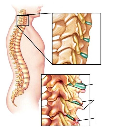 Coluna saudável e osteocondrose danificada