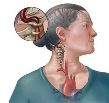Osteocondrose cervical levam à destruição dos discos intervertebrais da coluna