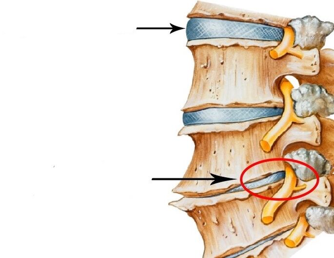 disco danificado e nervo violado com osteocondrose cervical