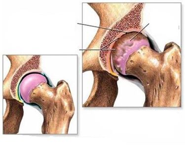 Artrose da articulação do quadril