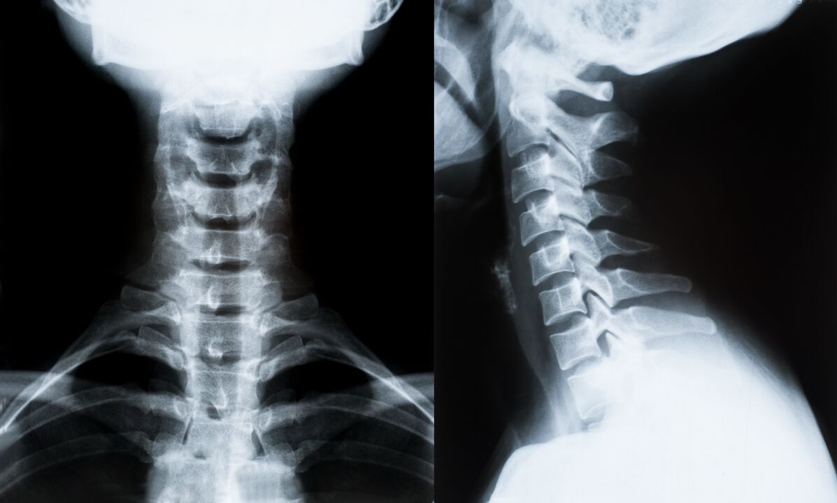 osteocondrose cervical em radiografia