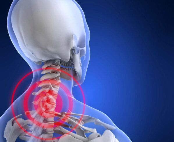 osteocondrose da coluna cervical