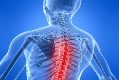 Compressão da medula espinhal na osteocondrose torácica